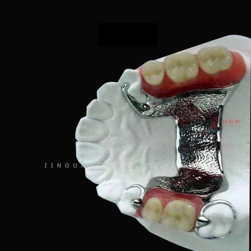 Hàm tháo lắp 3D‑printed + acrylic