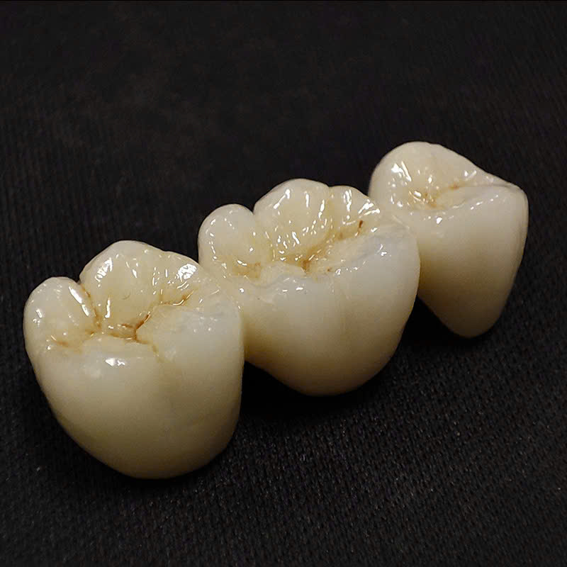 Cầu răng Zirconia liền mạch
