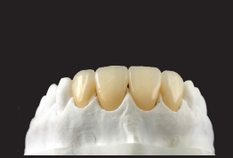 ABUTMENT ZIRCONIA CHO IMPLANT