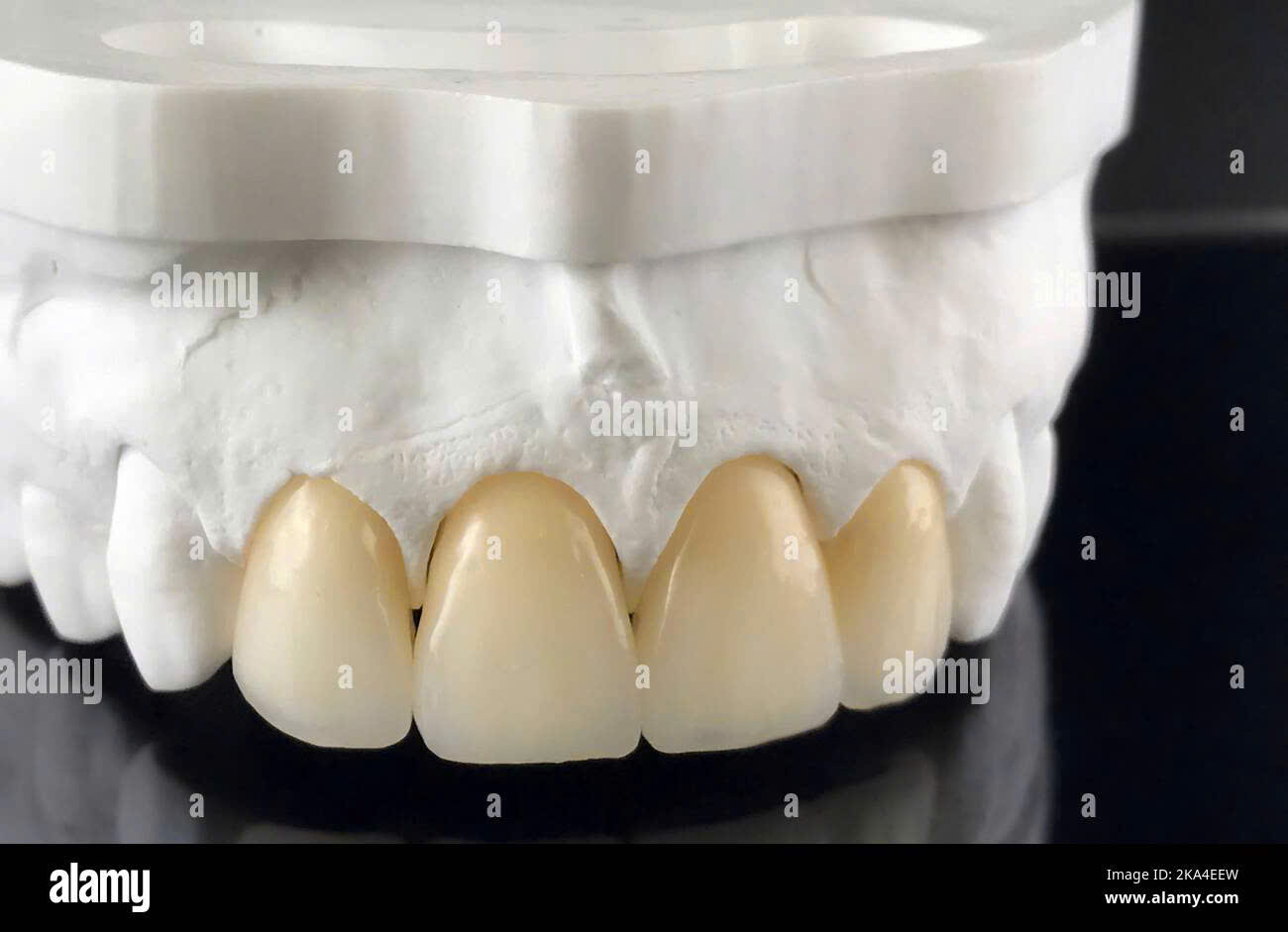 Răng sứ Veneer và Crown trên mẫu thạch cao
